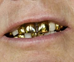 Зубы под колесами. Барнаульские стоматологи заделали ямы на дорогах гипсовыми челюстями